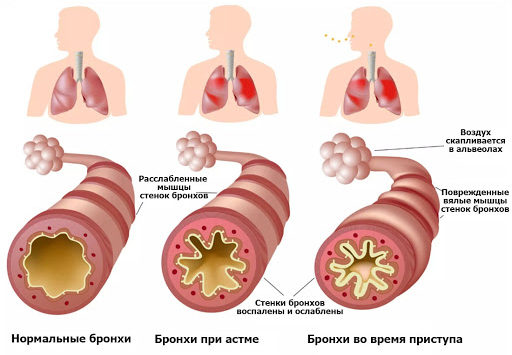 БРОНХИАЛЬНАЯ АСТМА