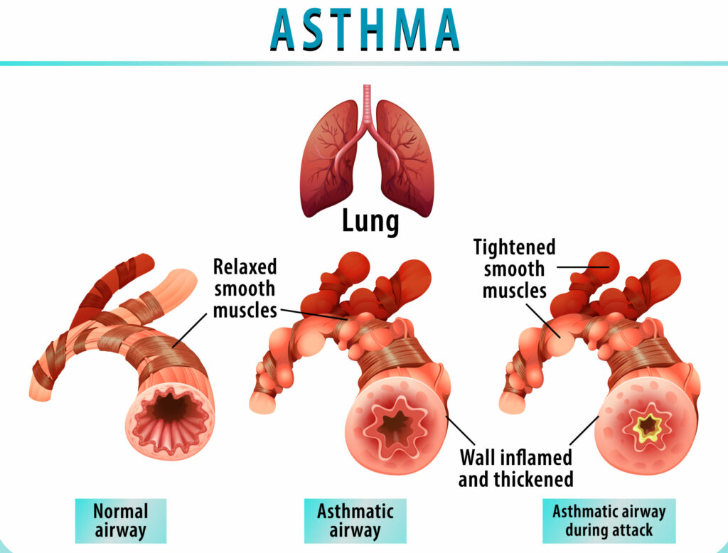 Bronchial Asthma diagram with normal airway and asthmatic airway