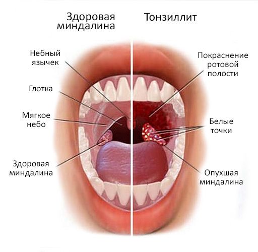 Лечение гнойной ангины в клинике Ардэниум | Симптомы, лечение гнойной ангины в Ижевске