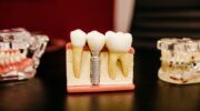 Материалы для протезирования зубов металлокерамикой