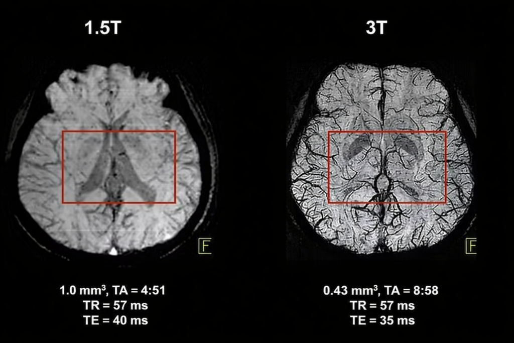 Сравнение МРТ головного мозга, выполненного на аппаратах 1.5 Тесла и 3 Тесла. Слева изображение с меньшим разрешением и детализацией, справа — с более высокой чёткостью и лучшей визуализацией сосудов и структур мозга.