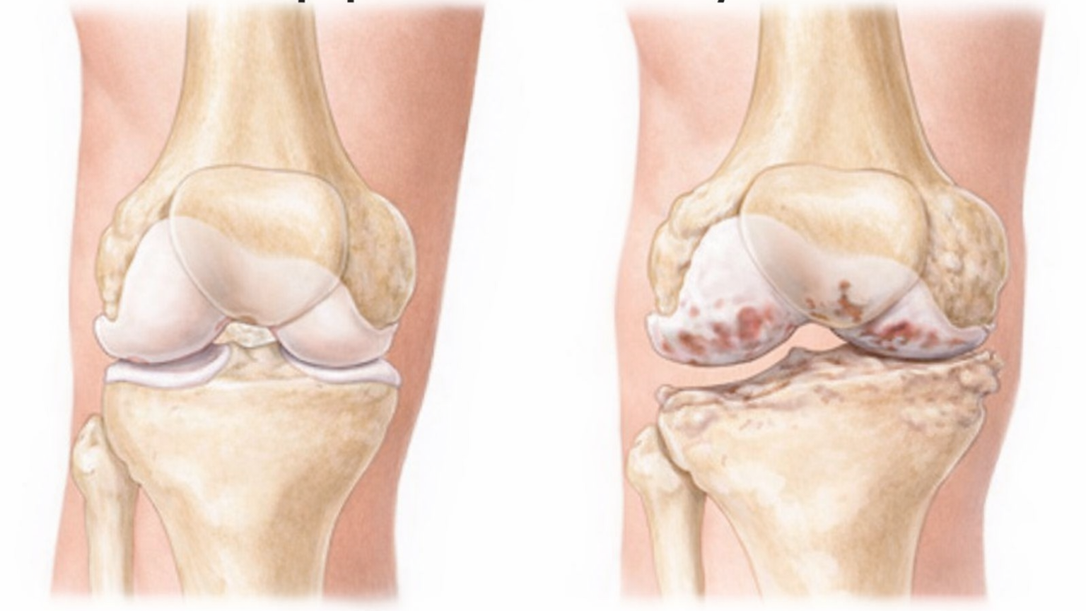артроз коленного сустава