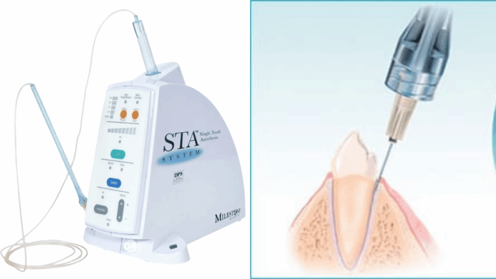 компьютерная анестезия в стоматологии аппарат STA System и схема введения анестетика